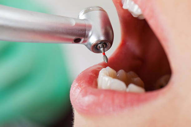 Best Chipped Tooth Repair Near Me  in Agua Fria, NM